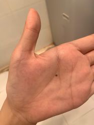 -北京美痣堂古方祛痣斑疣瘊