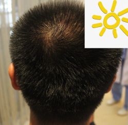 -大麦微针植发丨全国连锁