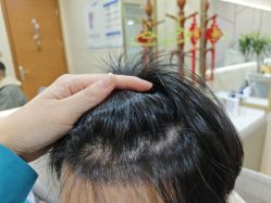 -碧莲盛·不剃发植发