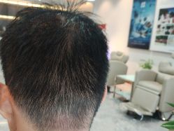 -碧莲盛·不剃发植发