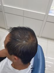 -大麦微针植发丨全国连锁