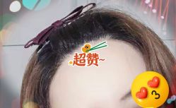 -大麦微针植发全国连锁