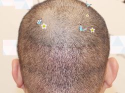 -大麦微针植发全国连锁