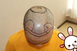 -大麦微针植发丨全国连锁