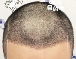 -大麦微针植发全国连锁