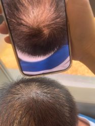 -碧莲盛·不剃发植发