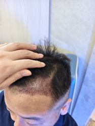 -大麦微针植发全国连锁