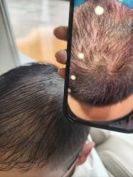 -碧莲盛·不剃发植发