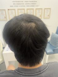 -大麦微针植发全国连锁