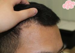 -大麦微针植发丨全国连锁