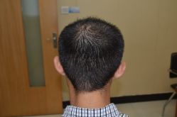 -大麦微针植发丨全国连锁