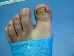 -Andrew指甲专科灰指甲·甲沟炎矫正·3D步态矫形鞋垫定制(浦三路店)
