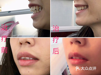 你是不是也担心牙齿矫正后会反弹？