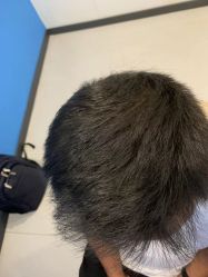-大麦微针植发全国连锁