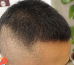 -大麦微针植发丨全国连锁