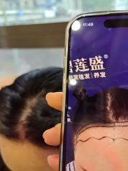 -碧莲盛·不剃发植发