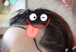 -大麦微针植发全国连锁