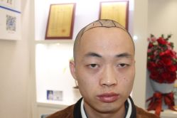 -大麦微针植发丨全国连锁