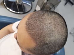 -大麦微针植发全国连锁