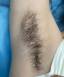 -薇兰专业脱毛连锁机构