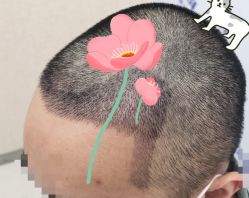 -大麦微针植发全国连锁