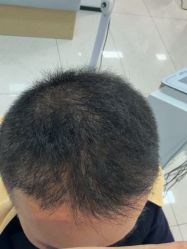 -大麦微针植发丨全国连锁