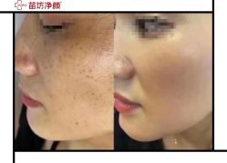 -苗坊净颜痘斑美容护肤连锁