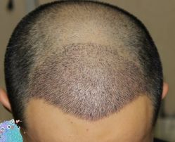 -大麦微针植发丨全国连锁