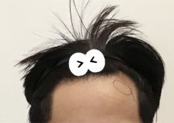 -大麦微针植发全国连锁