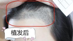 -大麦微针植发全国连锁