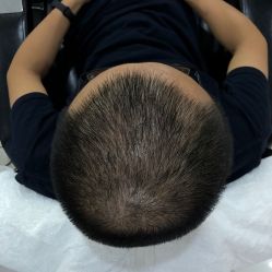 -大麦微针植发全国连锁