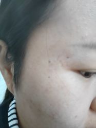 体验后-正璞医疗美容·皮肤修复·微整注射