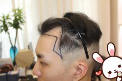 点击看大图 -大麦微针植发丨全国连锁