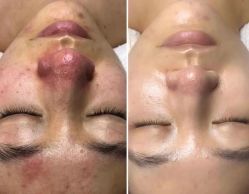 -美肤盾祛痘·问题肌头疗管理中心