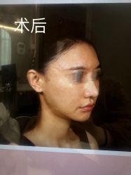 体验后-杭州米兰柏羽医疗美容医院