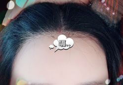 -大麦微针植发全国连锁