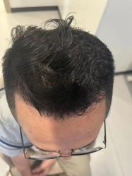 点击看大图 -大麦微针植发全国连锁