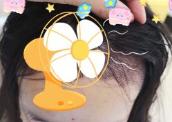 -大麦微针植发全国连锁