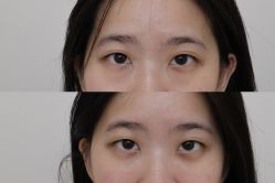 -广州健丽·去眼袋医疗美容机构