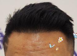 -大麦微针植发全国连锁