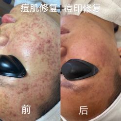 -美肤盾祛痘·问题肌头疗管理中心