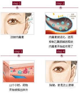 肉毒素多久见效