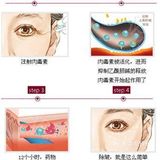 肉毒素多久见效