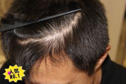 -大麦微针植发丨全国连锁