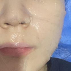 体验后-郑州米兰柏羽集美医疗美容医院