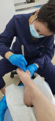 -德哥灰指甲脚气甲沟炎跖疣护理