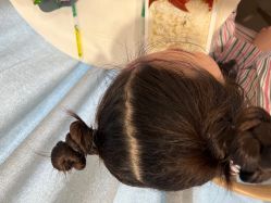 -碧莲盛·不剃发植发