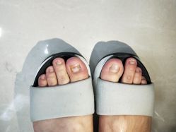 -德哥灰指甲脚气甲沟炎跖疣护理