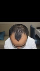 -大麦微针植发全国连锁