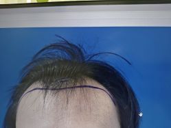 -碧莲盛·不剃发植发